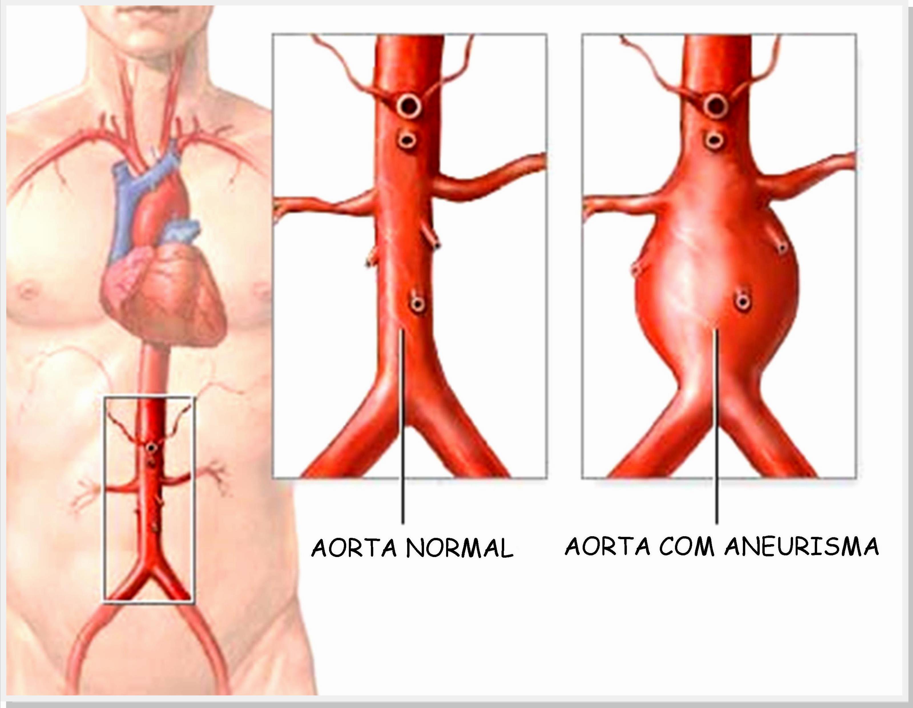 Aneurisma de Aorta