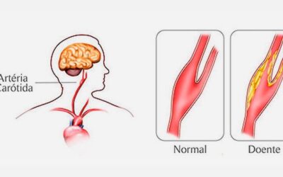 Obstrução das Carótidas