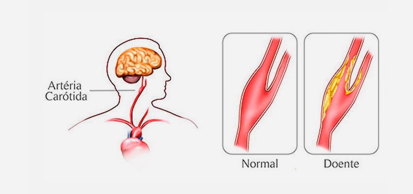 Obstrução das Carótidas