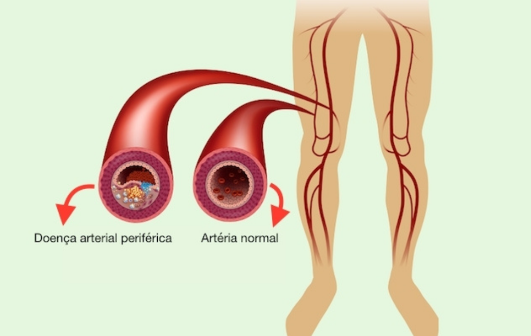 Doença Arterial Obstrutiva Periférica