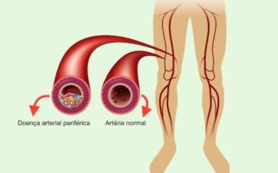 Doença Arterial Obstrutiva Periférica