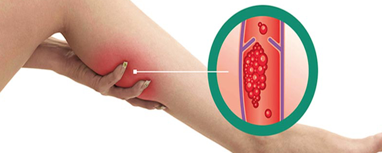 Trombose Venosa Profunda